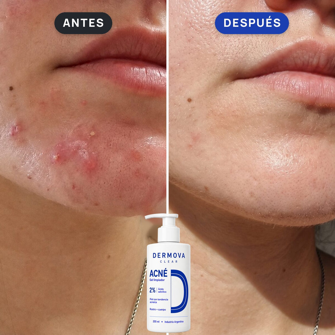 Antes y después: acné en el mentón