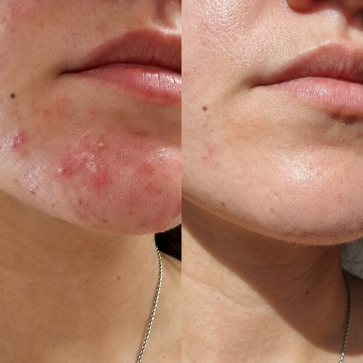 Antes y después mentón